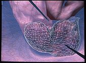 Laparoscopy