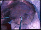 Laparoscopy