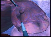Laparoscopy