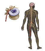 Sciatica caused from herniated disc.