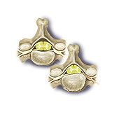 View of normal vertebra on left. On right is view of vertebra with spinal stenosis showing trapped nerve.
